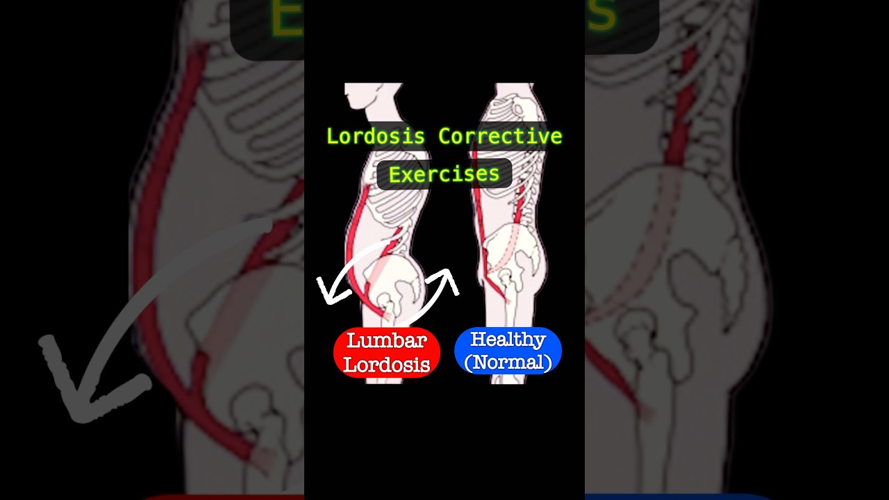 Fix Lordosis Fast | 4 Corrective Exercise for Better Posture. #lordosis #pelvictilt #backpainrelief