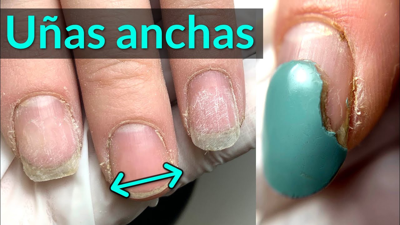 Transformación de Uñas ANCHAS