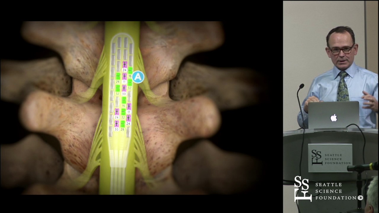 Spinal Cord Stimulation Update by Ryder Gwinn, M.D.