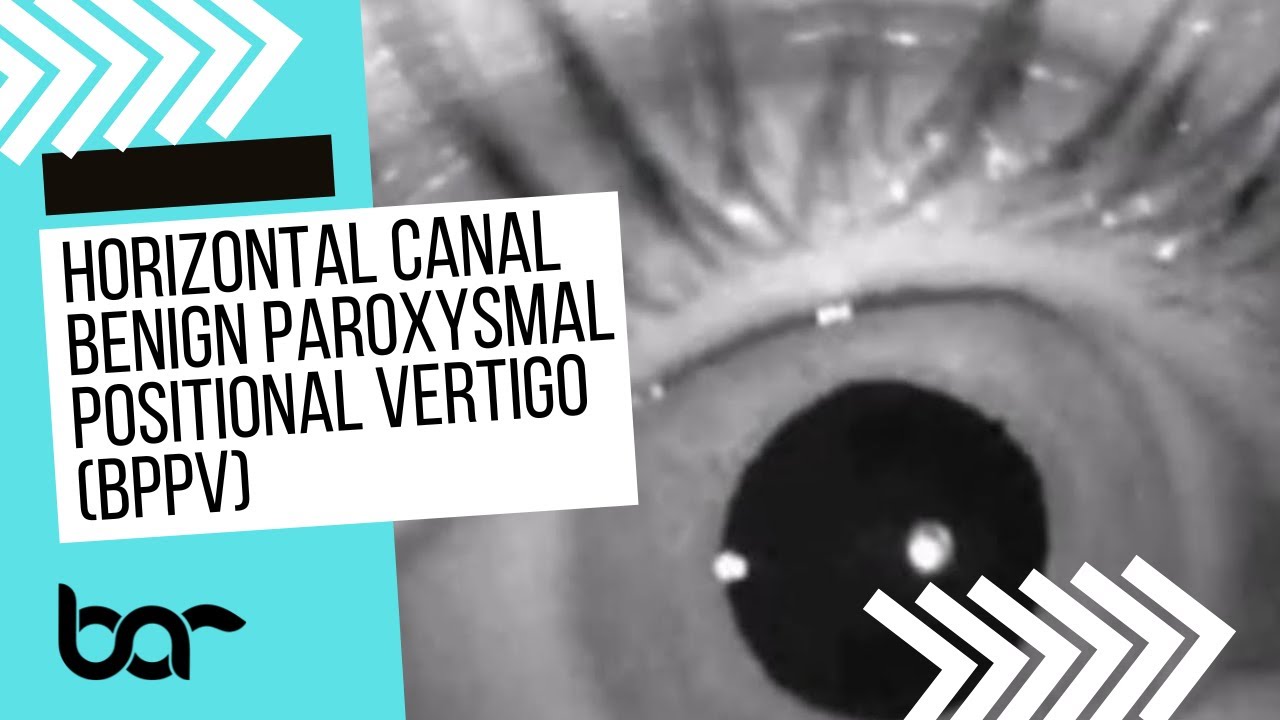 Движения глаз (нистагм) при ДППГ горизонтального канала (дополнительный материал к эпизоду «Погов...