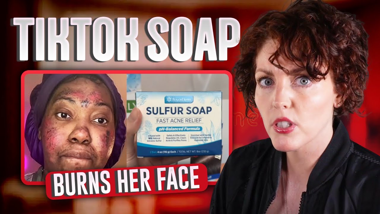She Got Chemical Burns from Viral Acne Soap? Skincare Expert Reacts