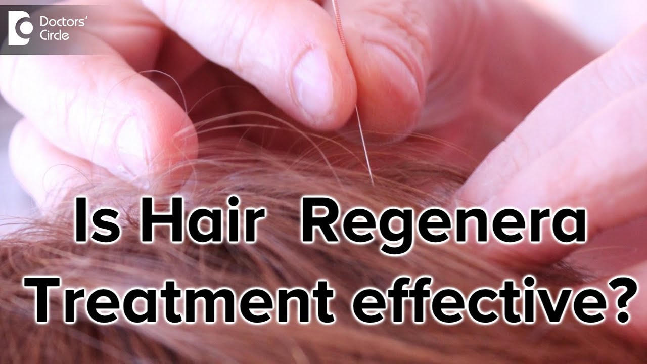 Hair Regenera Treatment for hair regrowth effective? - Dr. Aruna Prasad