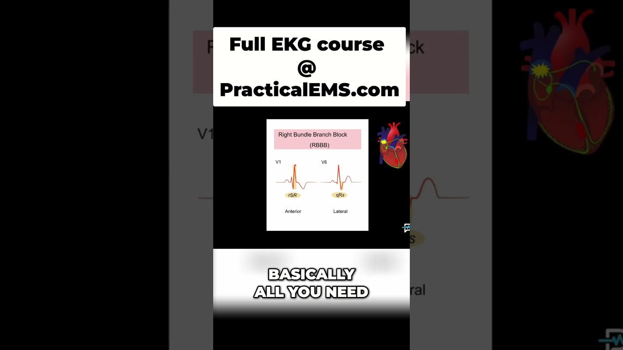 RBBB: Spotting the 'Rabbit Ears' on Your EKG (Easy Guide!) #shorts