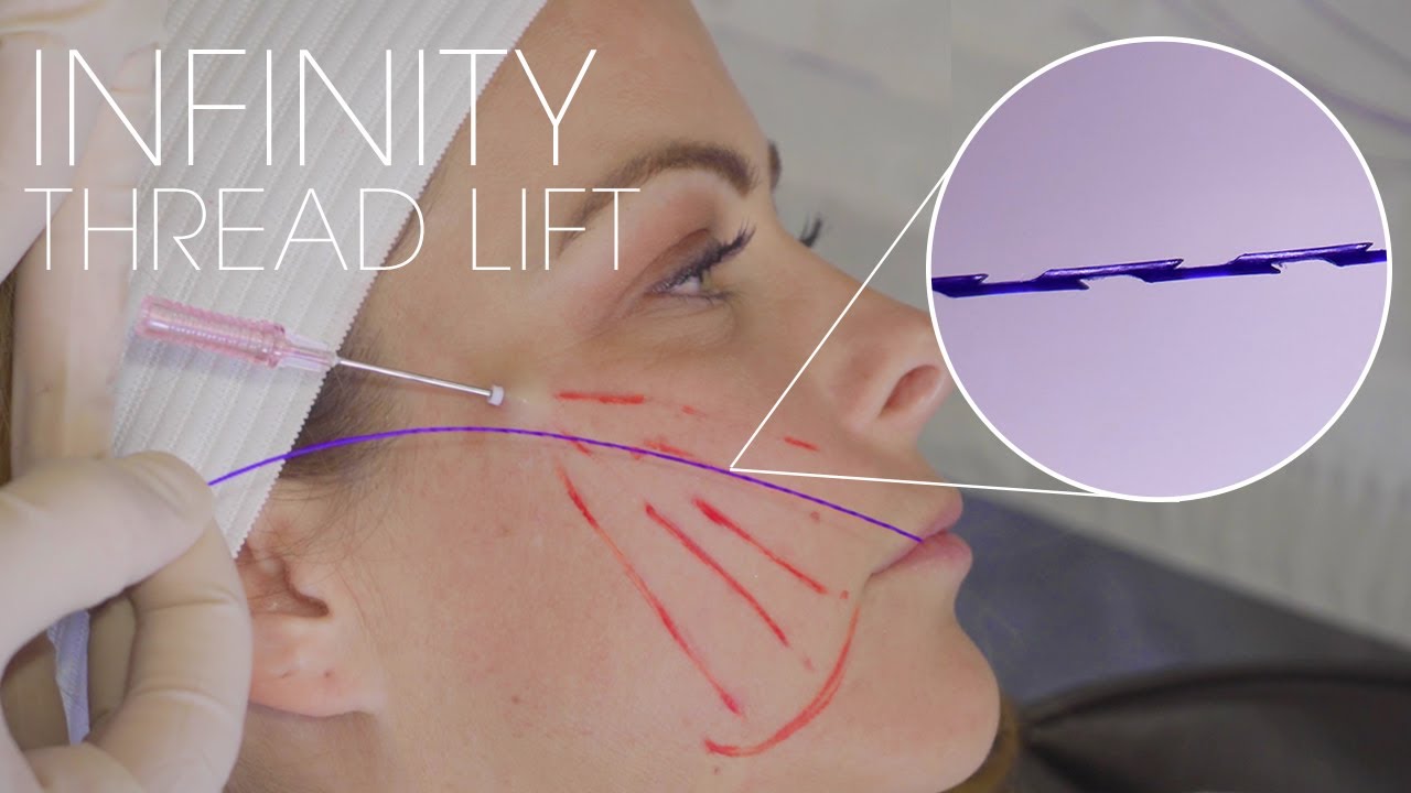 Lifting nicią Infinity z wypełniaczem podbr&oacute;dka i linii żuchwy: Terapie łączone dr. Kiana Karimiego