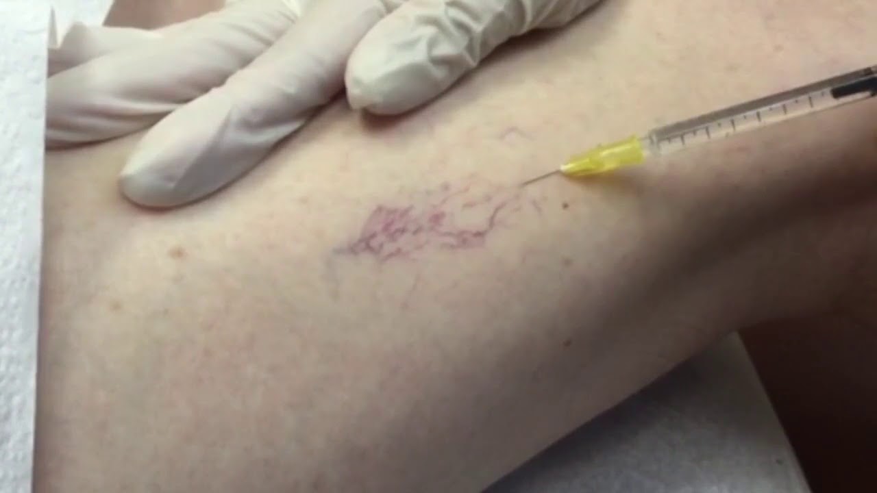 Spider Veins and Varicose Veins Treatment | Irvine Skin