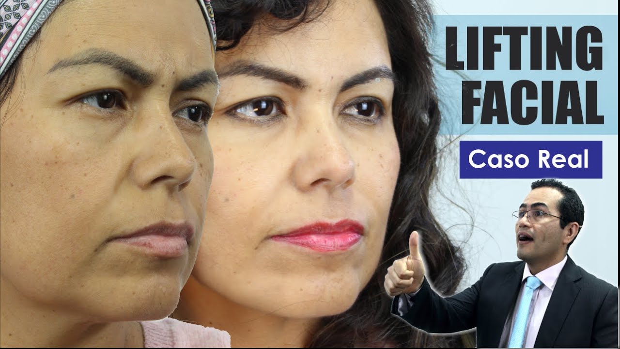 LIFTING FACIAL 🧡 Rejuvenecimiento del rostro ANTES y DESPUES 👸 Dr Percy Nevado 💕 CIRUGÍA PLASTICA