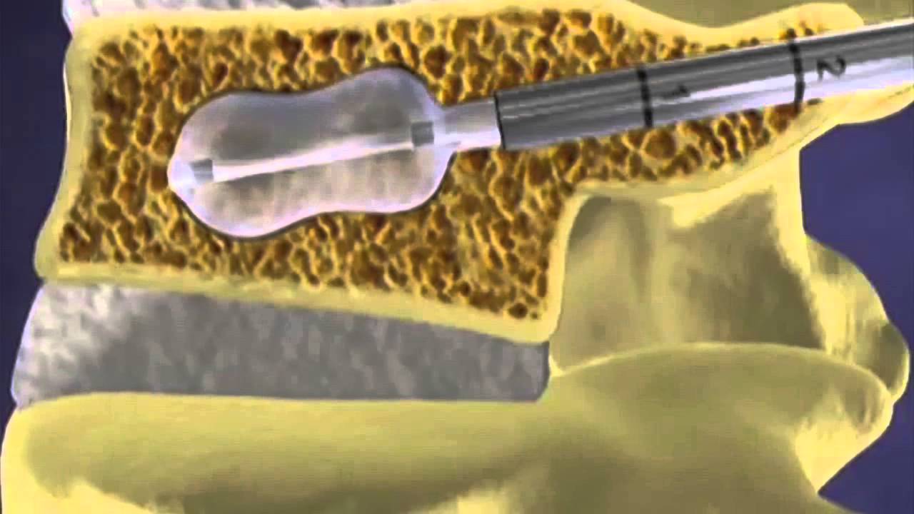 Fixing a Fractured Spine