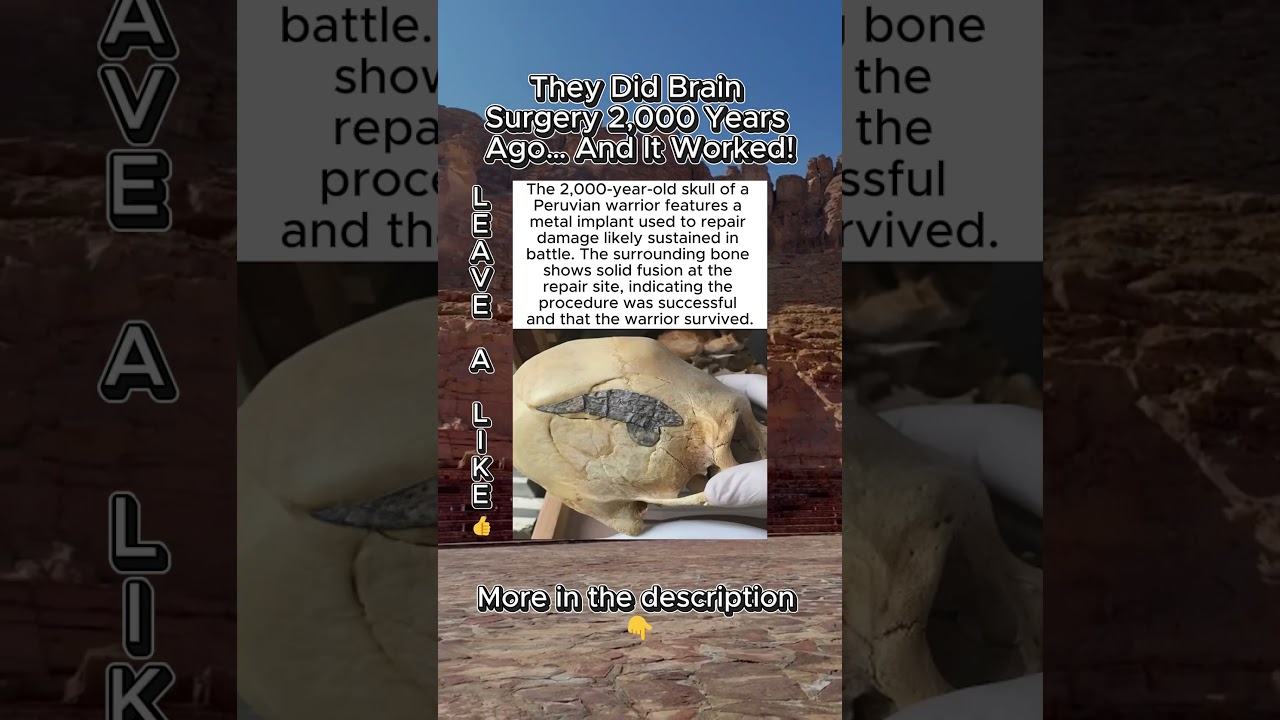 Peruvian Warrior Survived Metal Implant Surgery 2,000 Years Ago ⚔️🦴