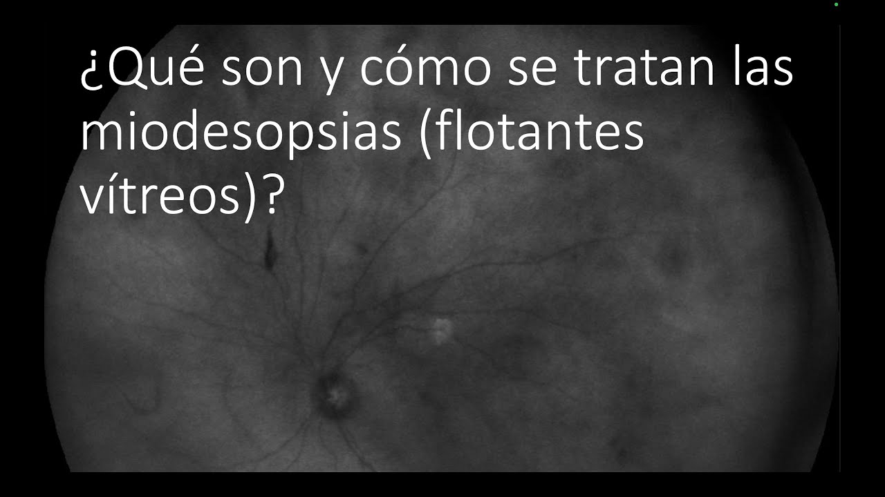 ¿Qué son y cómo se tratan las miodesopsias (moscas volantes, flotantes o condensaciones vítreas)?