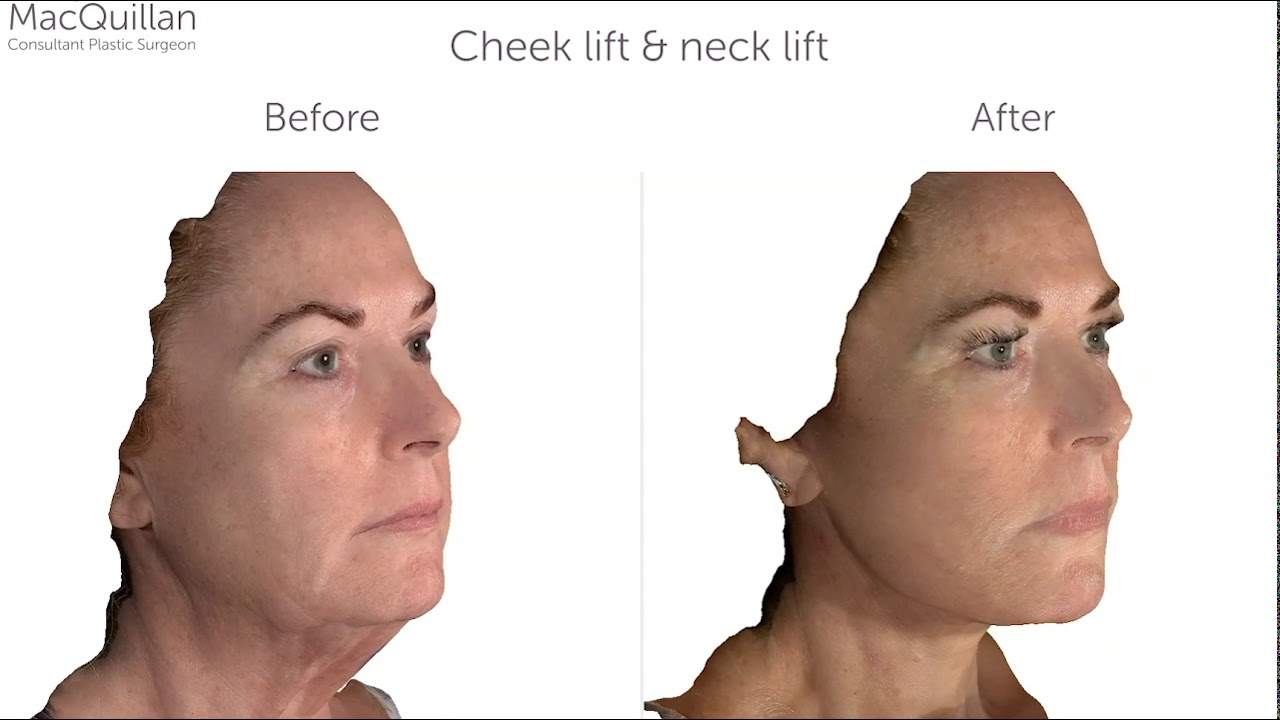 Cheek and Neck Lift