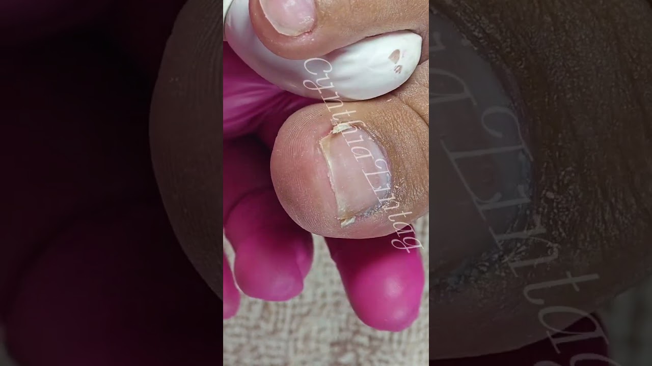 Full video pedicure with ingrown removal 