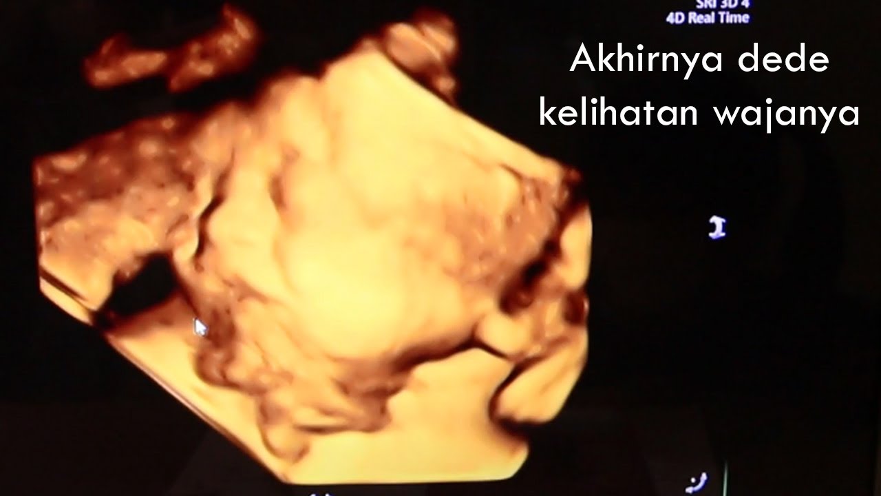 CEK USG KEHAMILAN 37 MINGGU BAYI NGUMPET