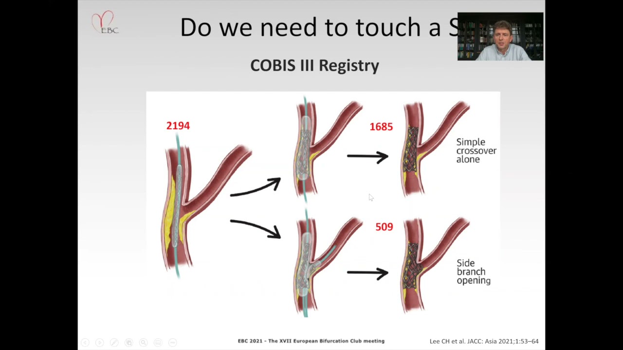 How to decide to treat or not to treat the side branch in Provisional stenting - Dr Marek LESIAK