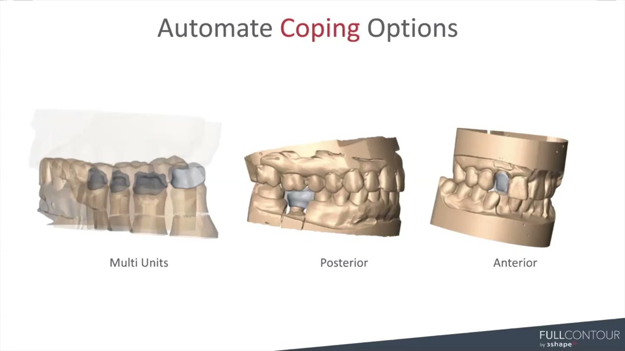 3Shape Automate – Copings