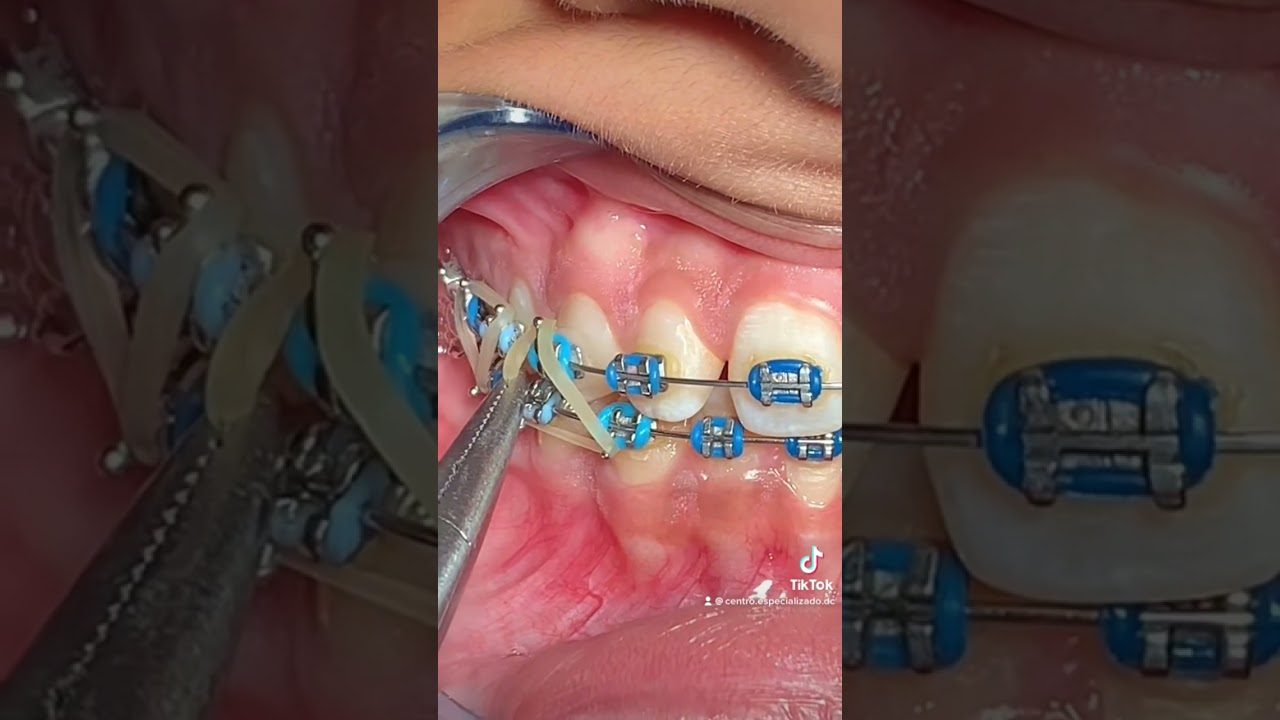 &iexcl;Hules en forma de triangulo en los frenillos met&aacute;licos!