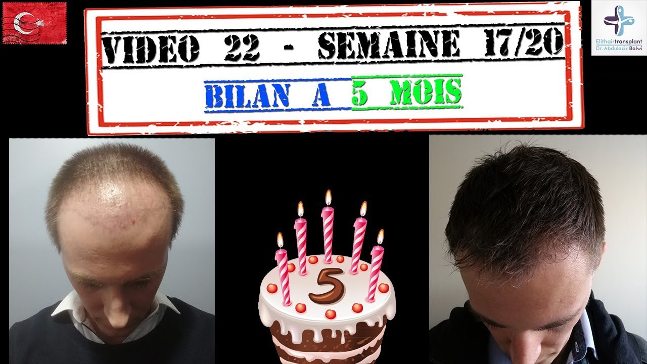 Bilan 5 mois de Ma greffe de cheveux FUE en Turquie [22]
