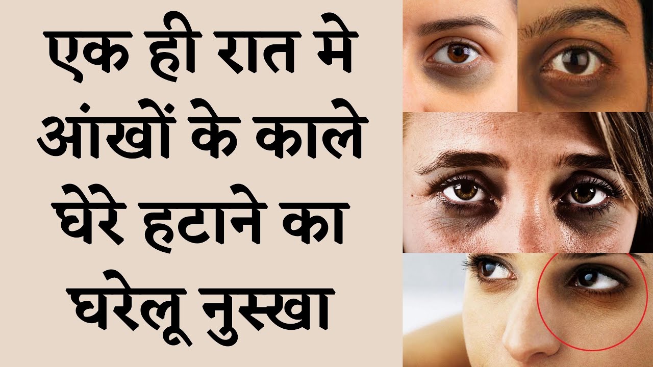 HOW TO REMOVE DARK CIRCLES I काले घेरे कैसे ठीक करें, BEST TREATMENT FOR DARK CICLES I DR. MANOJ DAS