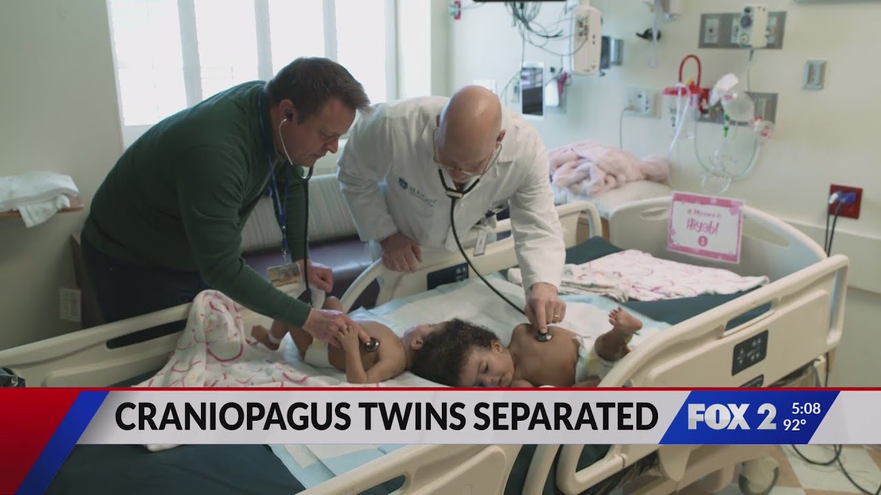 Twin sisters conjoined at the head successfully separated in St. Louis