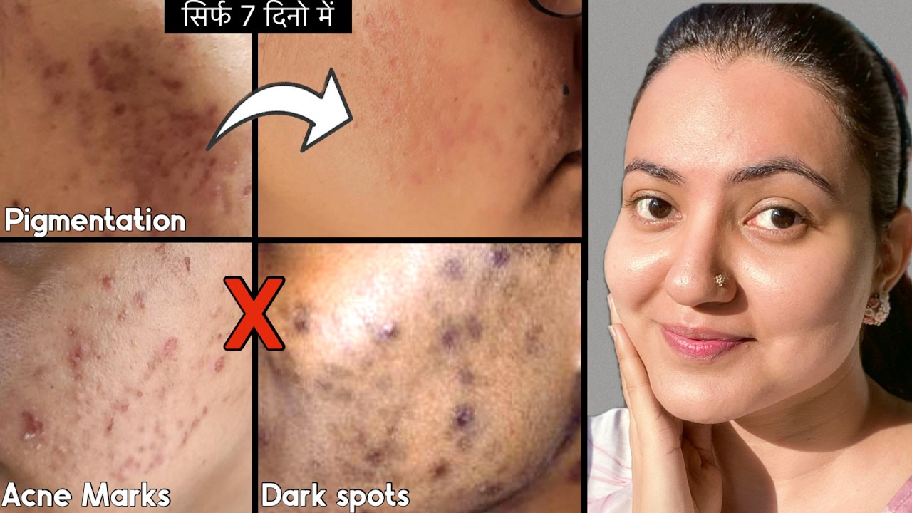 कितने भी मुश्किल झाइयाँ काले धब्बे Pigmentation, Dark Spots हो, इस Remedy से होगा 100% इलाज