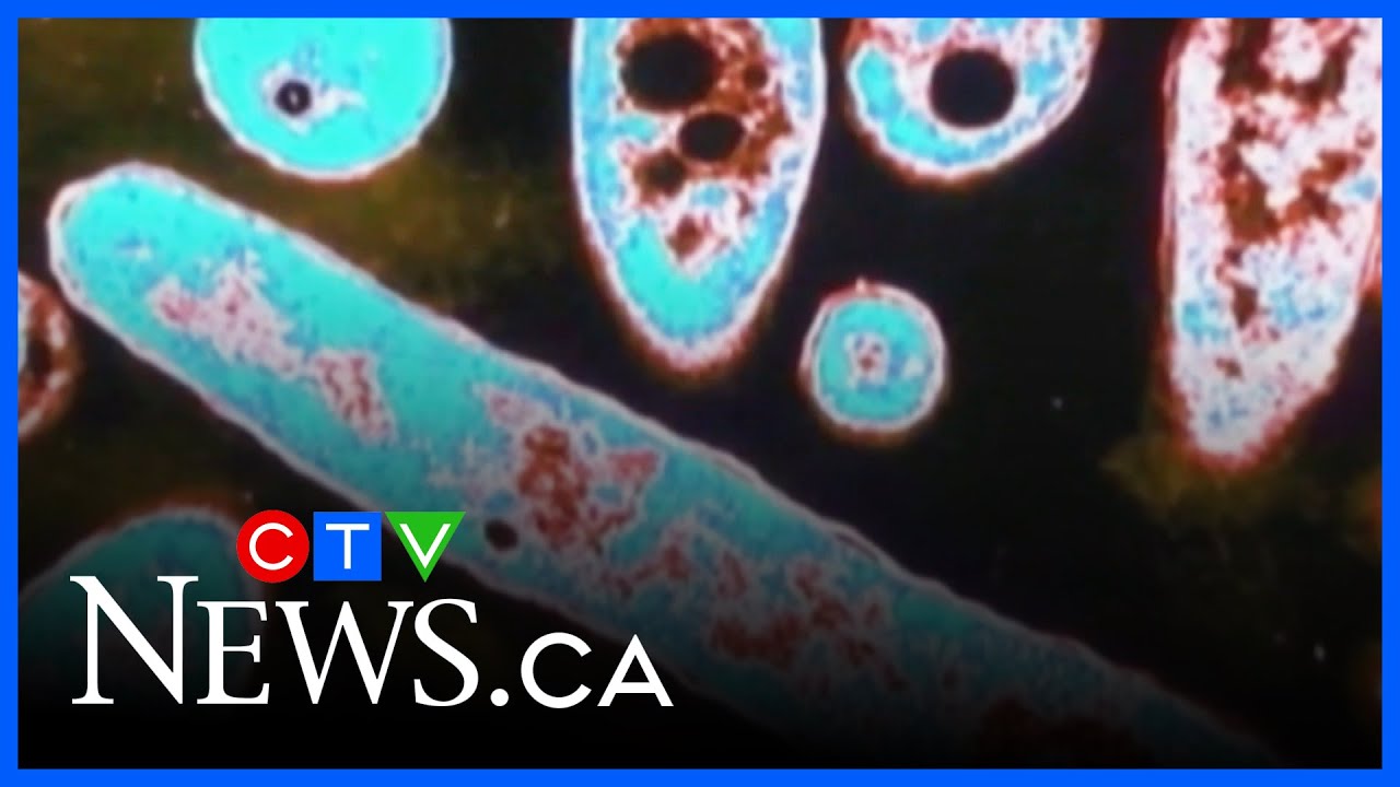 Everything you need to know about Legionnaires’ disease