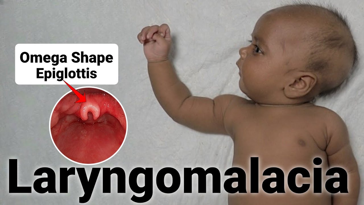 Laryngomalacia