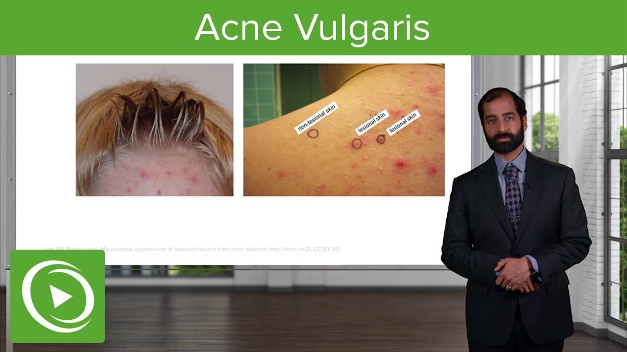 How Does Acne Develop? Learn the Science Behind It! 🧬