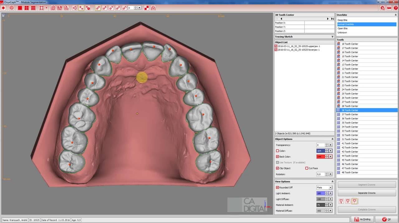 OnyxCeph-CA Smart3D - Segmentation