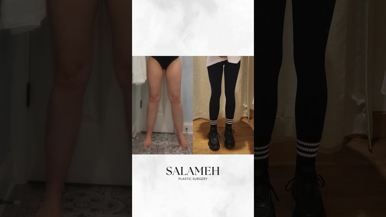 Lipedema Before and After Transformation #lipedemaawareness #beforeandafter