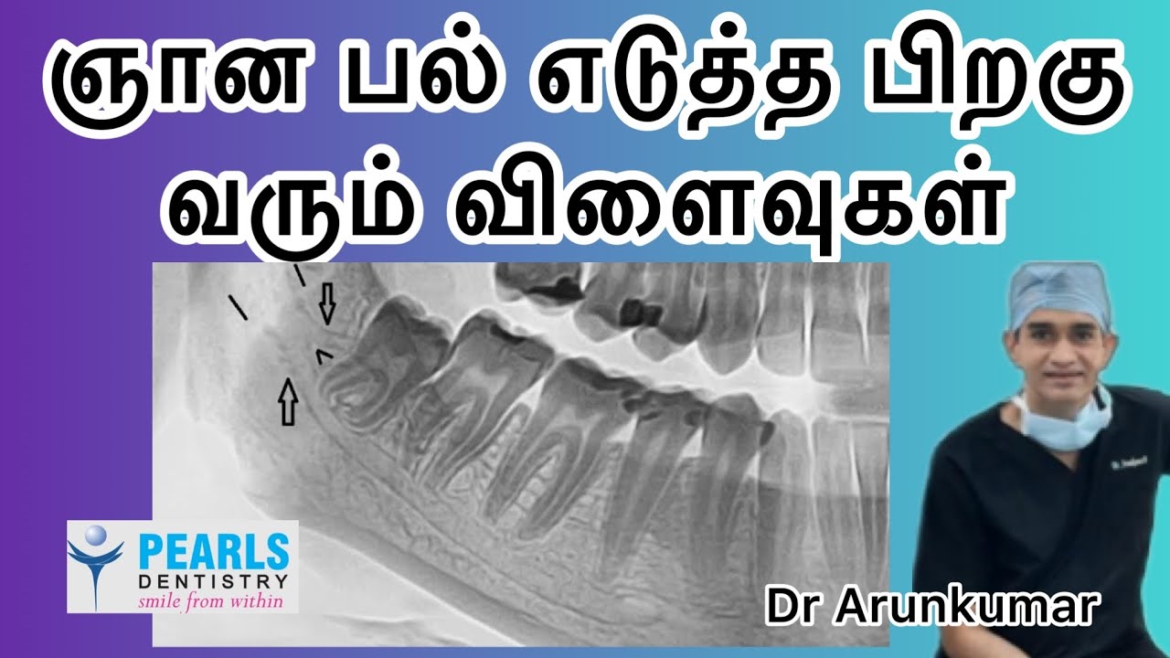 ஞான பல் எடுத்த பிறகு வரும் விளைவுகள் | Dr Arunkumar | Pearls Dentistry