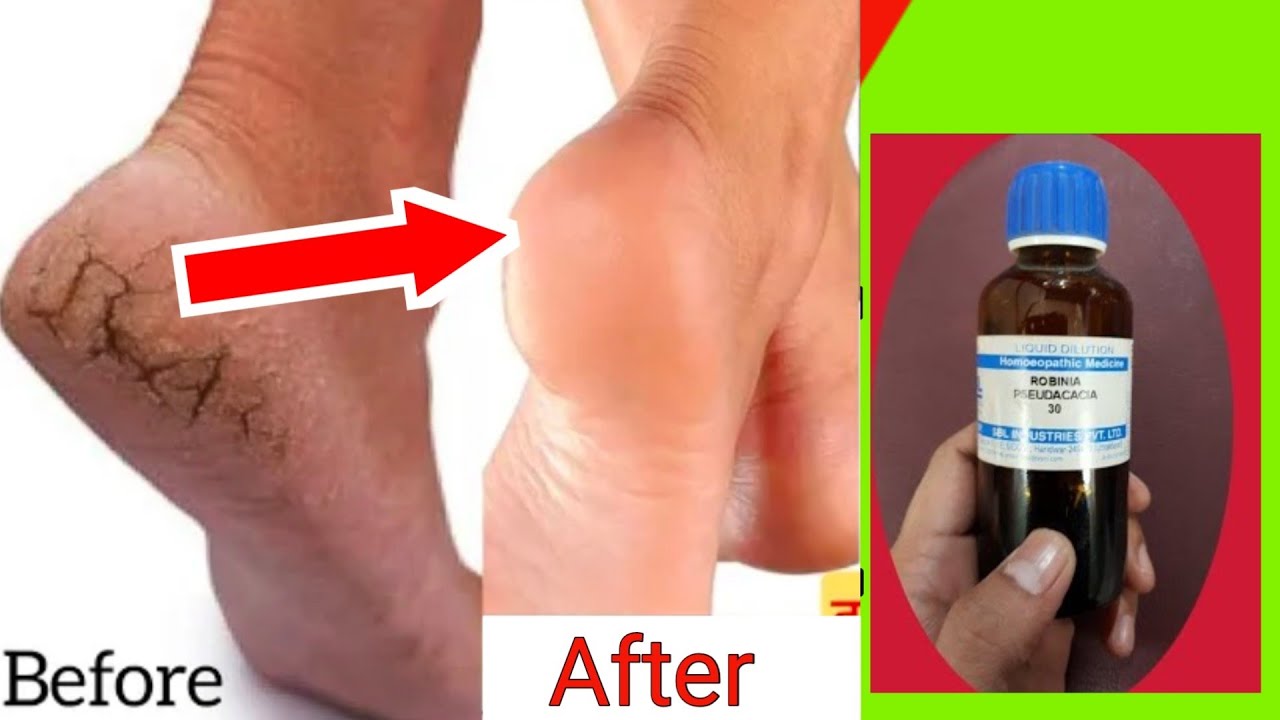 फटी एड़ियों के लिए जबरदस्त दवा। fati ediyon ke liye jabardast dawa / cracked heels remedy