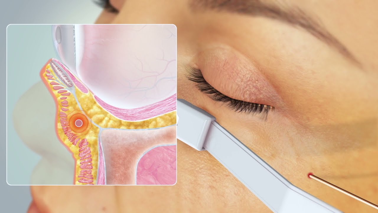 Lidstraffung mit Radiofrequenz (AccuTite)