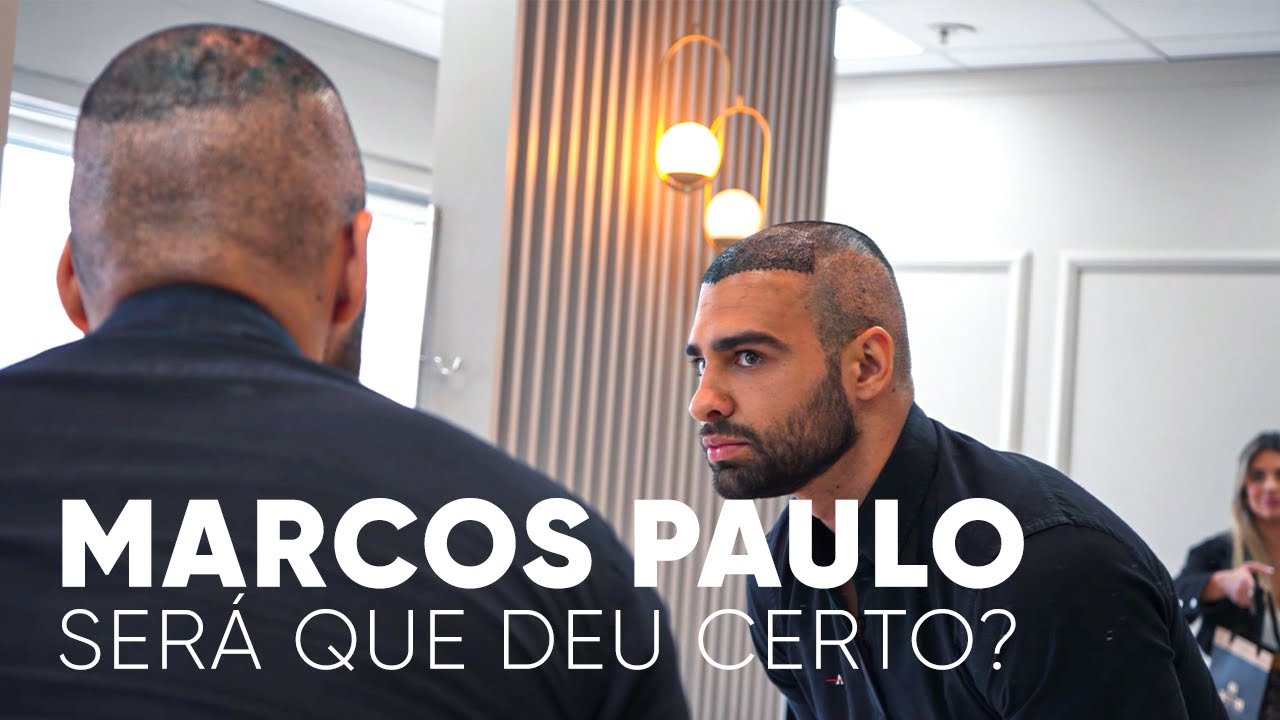 DOCUMENTÁRIO: O TRANSPLANTE CAPILAR | Marcos Paulo
