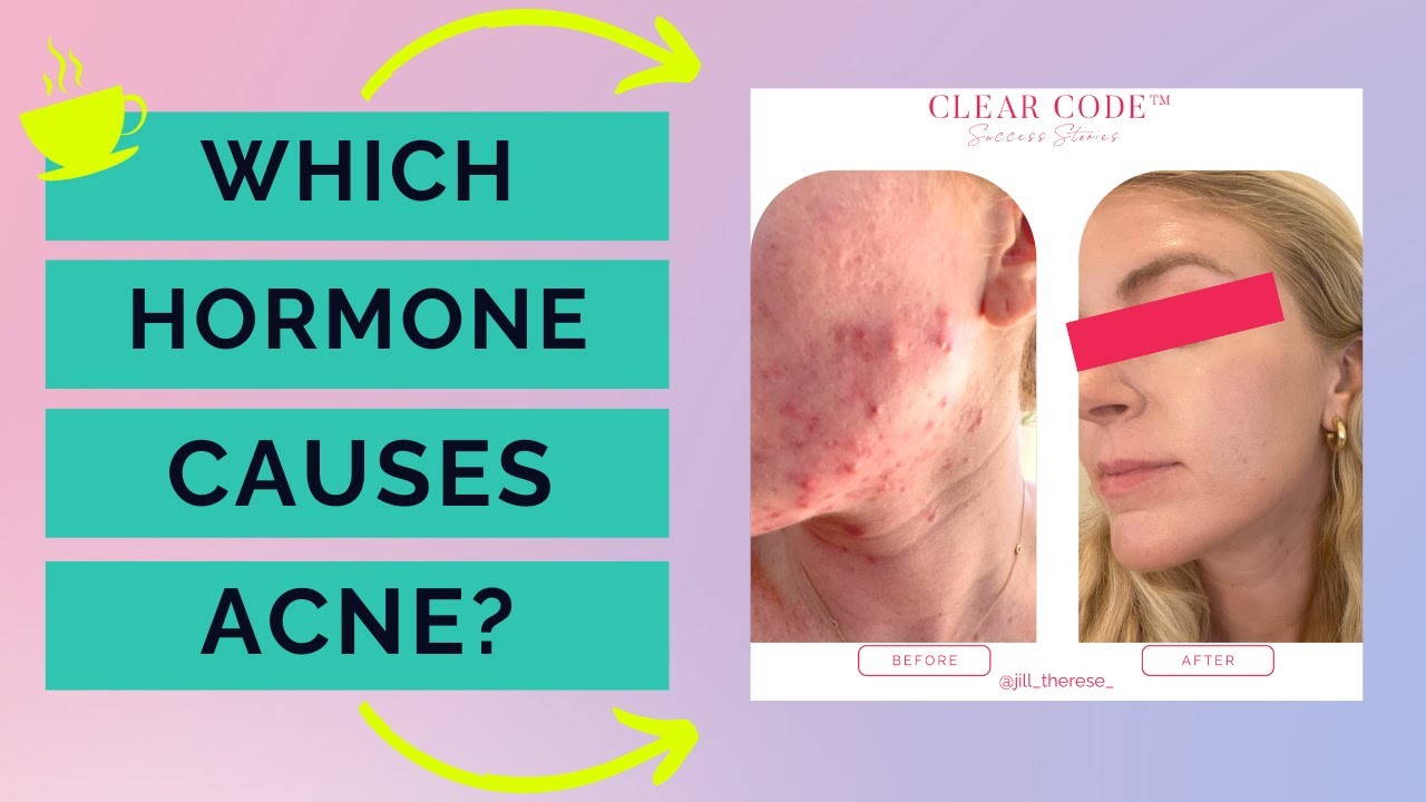 Hormonal imbalances that cause acne - does COFFEE cause acne?!