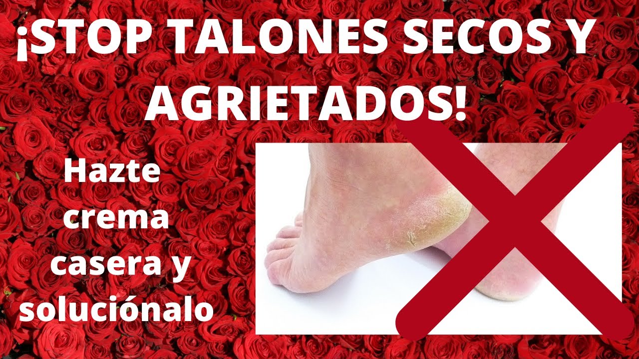 ➡️ CREMA casera para  TALONES SECOS Y AGRIETADOS con urea 🦶🦶