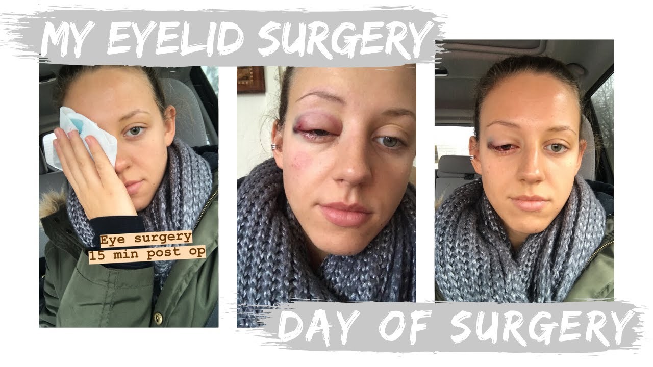 My Eyelid Surgery | FIXING MY DROOPY EYELID | Day of Surgery