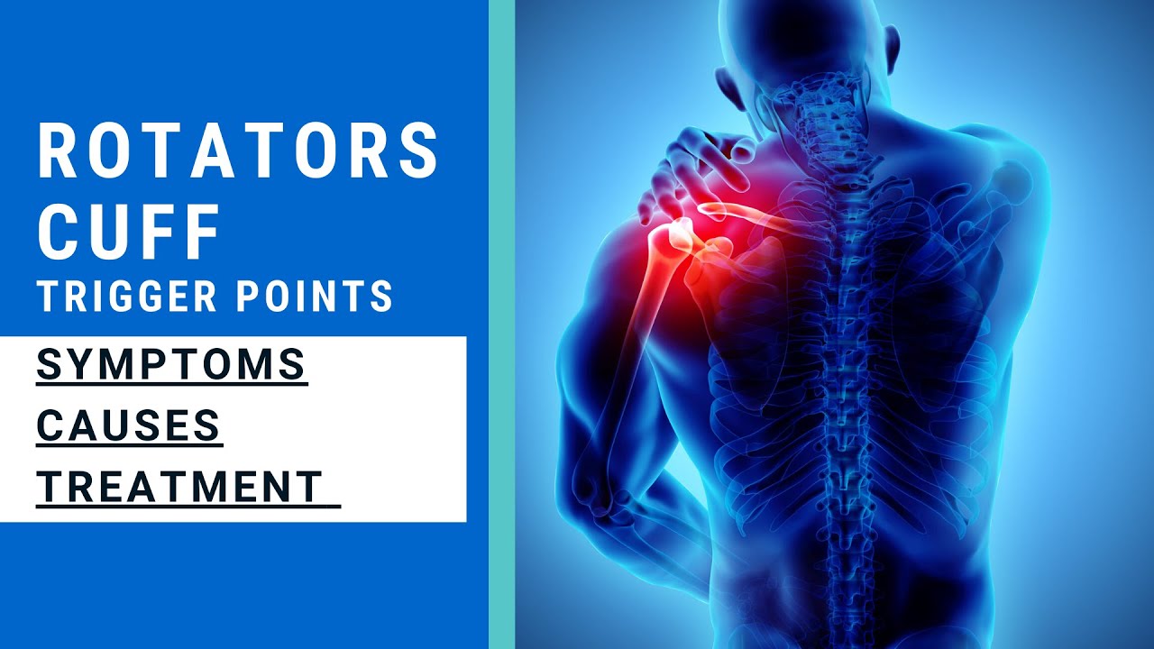 Rotator Cuff Tear - Trigger Point of the Week
