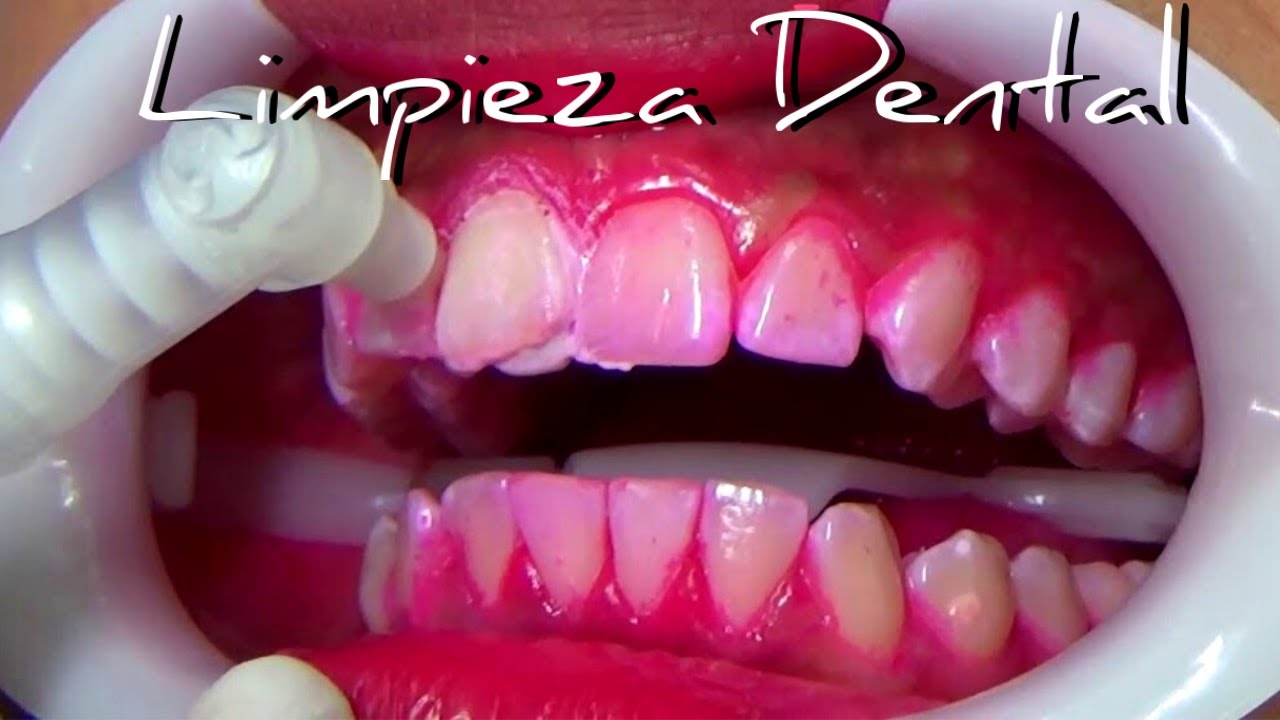 Que es una limpieza dental ¿como se hace profilaxis dental?
