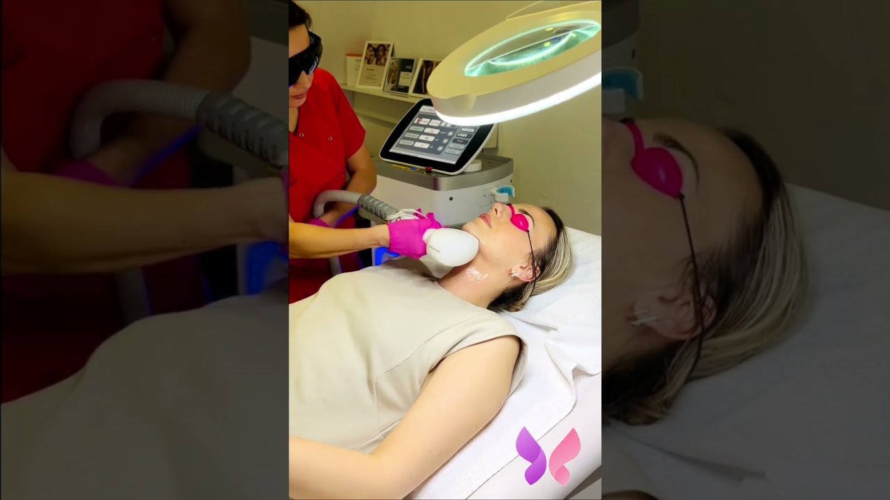 Laserska epilacija lica