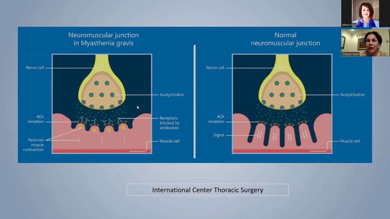 Antibody types of Myasthenia Gravis