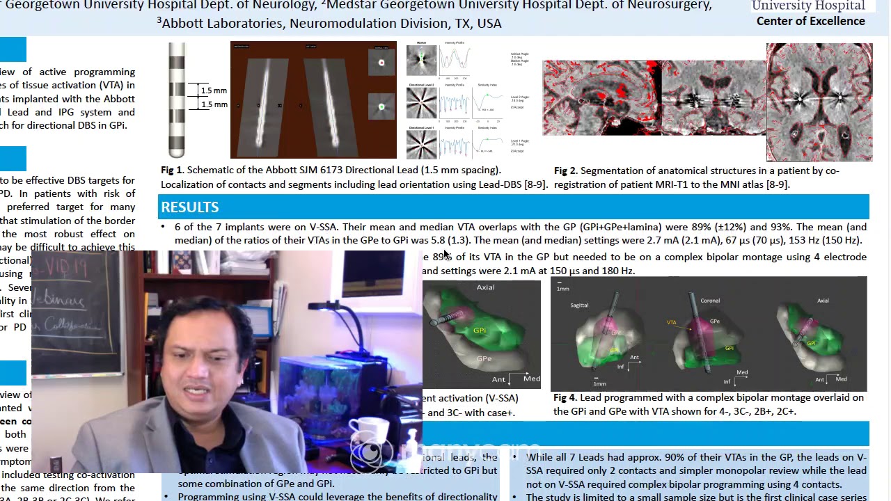 Complex Directional Stimulation using Segmented Leads, Deep Brain Stimulation for Parkinson Disease