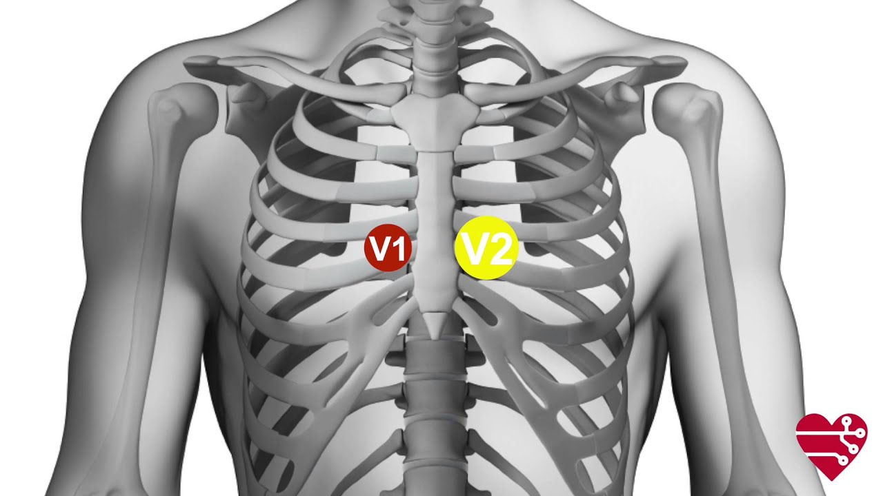 ECG - Come si posizionano gli elettrodi?