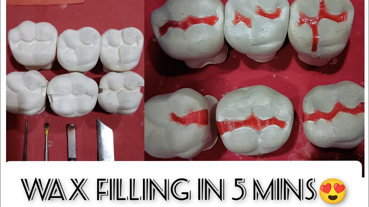 Refining Wax Filling on Plaster Models in 5 Minutes! 😍 Explained in Detail! #gdcmumbai #bds