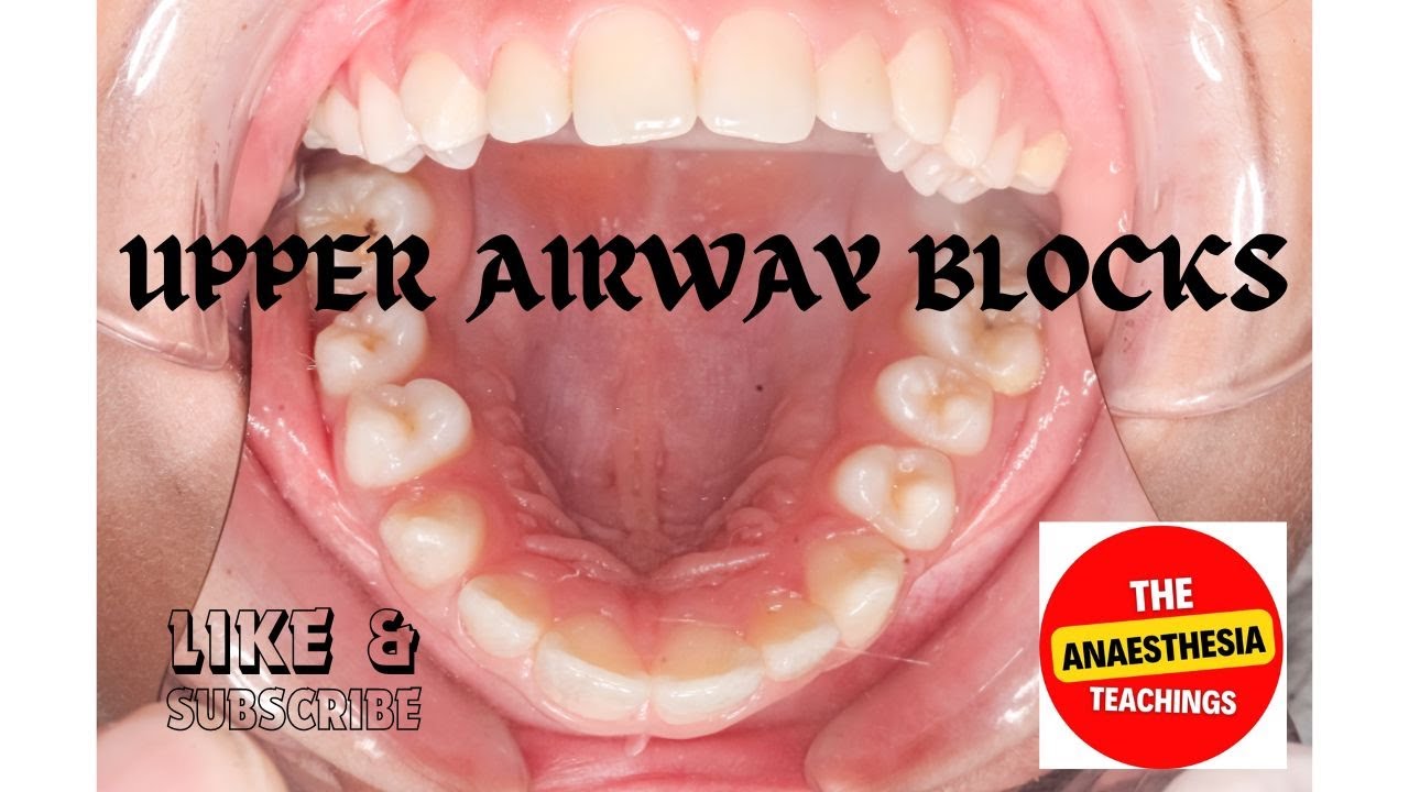 Upper Airway Blocks made super easy//awake intubation made easy