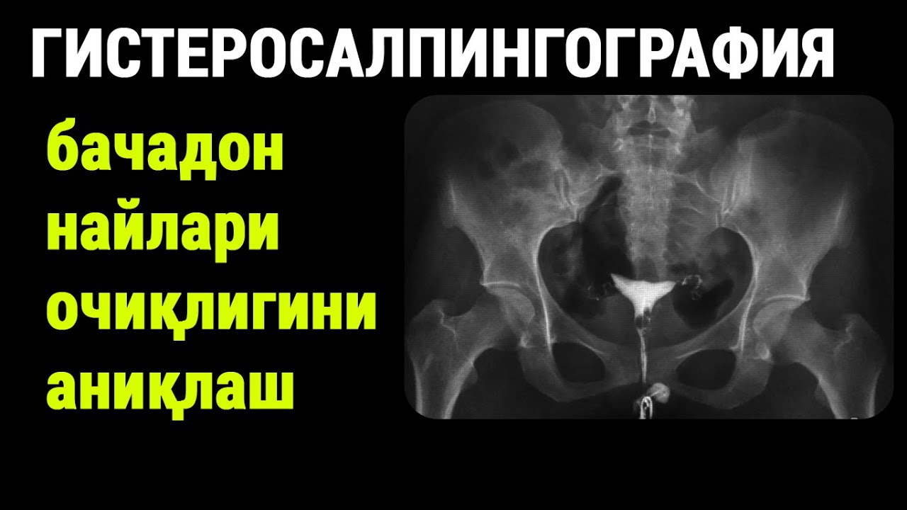 Гистеросалпингография: бачадон найлари очиқлигини аниқлаш