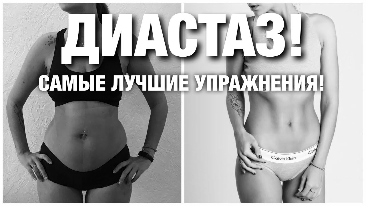 ВИСИТ ЖИВОТ? ДИАСТАЗ? Упражнения ПРИ ДИАСТАЗЕ!