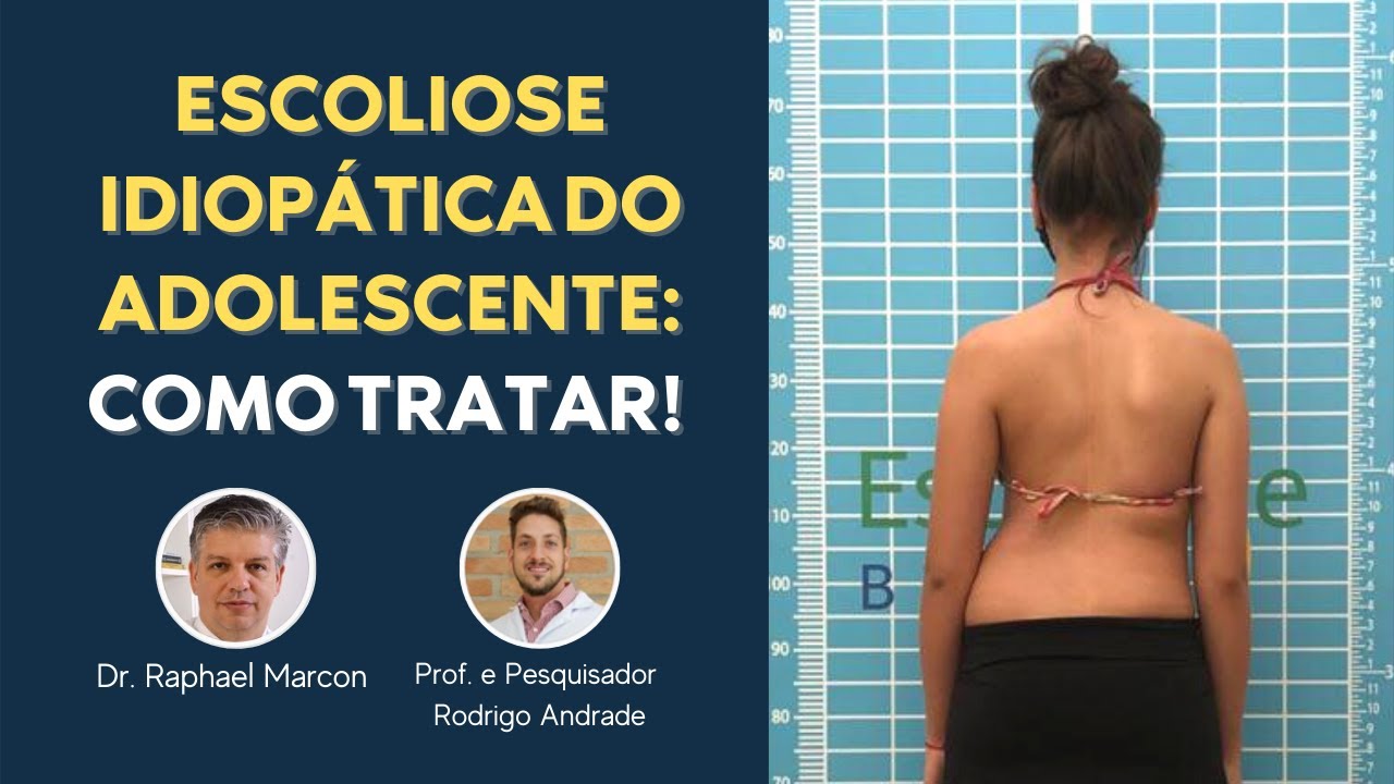 ESCOLIOSE IDIOP&Aacute;TICA DO ADOLESCENTE: COMO TRATAR!