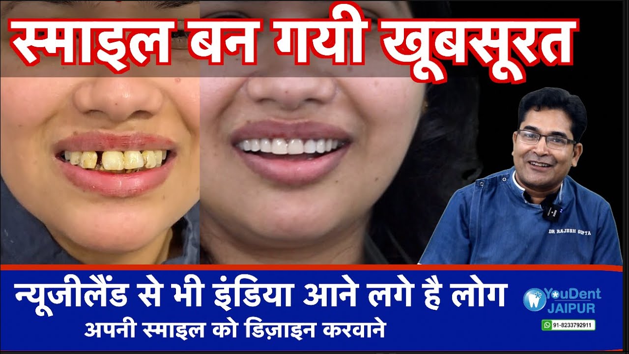अब स्माइल को लेकर दुःखी ना हो , कैसी भी स्माइल हो खूबसूरत बनायीं जा सकती है। smile makeover