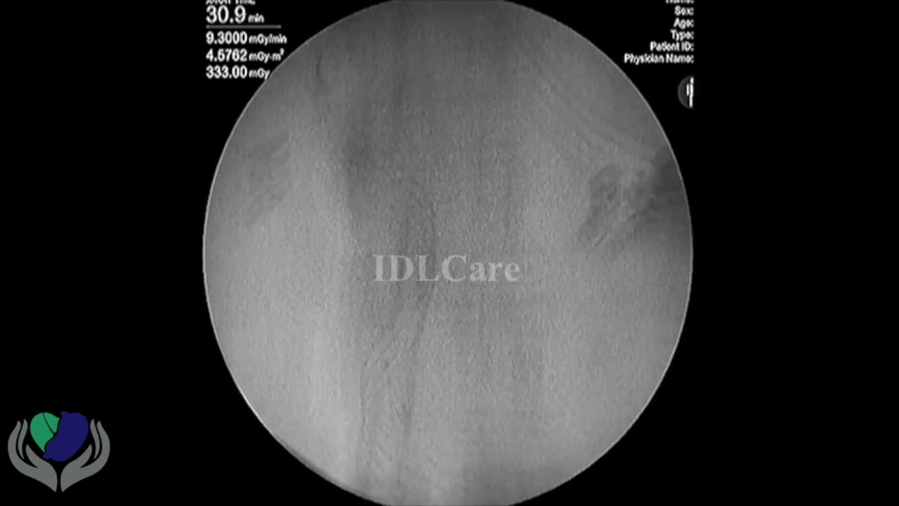 EUS-Guided Antegrade Trans-papillary Metal stenting