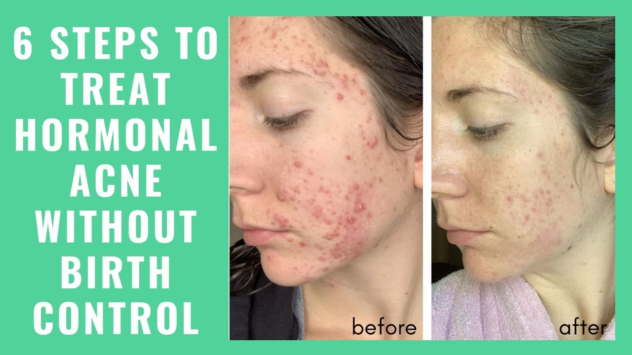 Treat hormonal acne without birth control - fast!