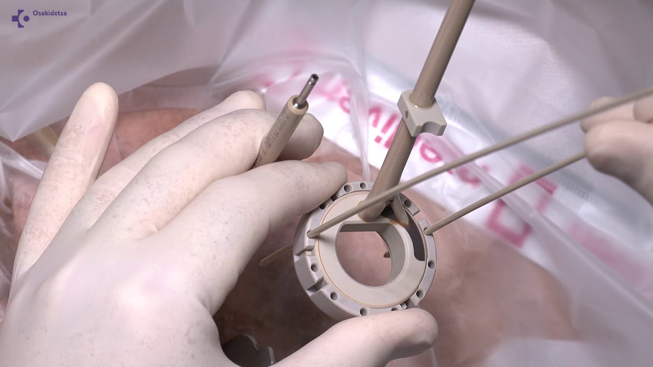 Magnetic Resonance Image guided Brachytherapy for Cancer of the Cervix.